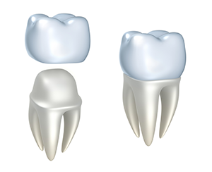 Dental Crowns | Dentist In Venice, FL | Dixie Jernigan, DMD
